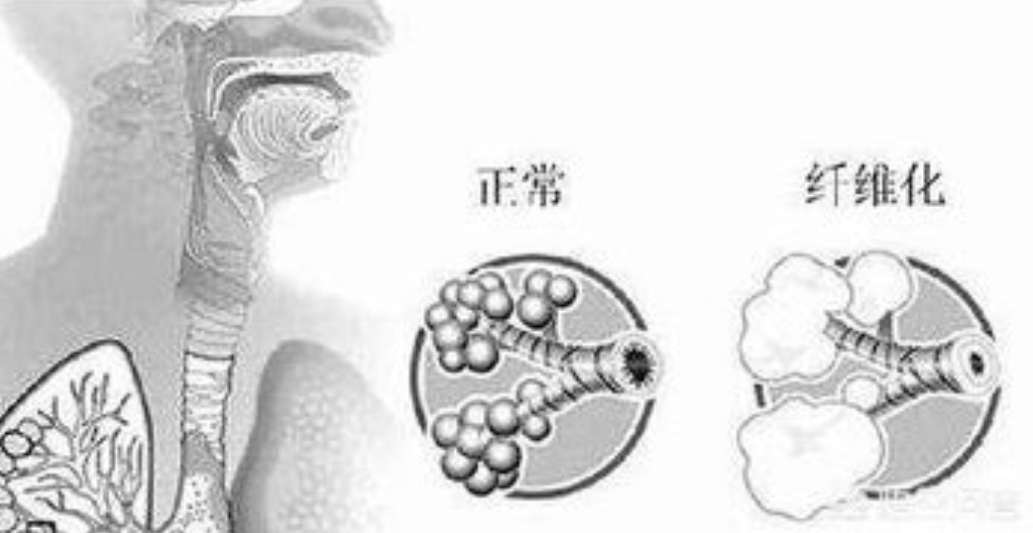 儿童纤维化间质性肺病治疗新希望